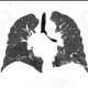 Hypersensitivity pneumonitis, subacute: CT - Computed tomography